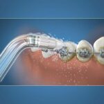 Waterpik Oral Irrigator Tip - Orthodontic - Removes Plaque - Special for Dental Appliances - Image 2