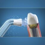 Waterpik Plaque Seeker Oral Irrigator Tip - Plaque Seeker - Image 2