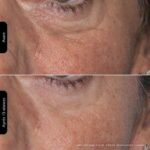 Silk'n Lumino - Mask Led Luminotherapie 100leds - Automatic routine programs - anti aging / anti imperfection sessions - Image 5